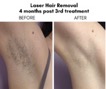 laser+hair+removal