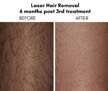 laser+hair+removal2